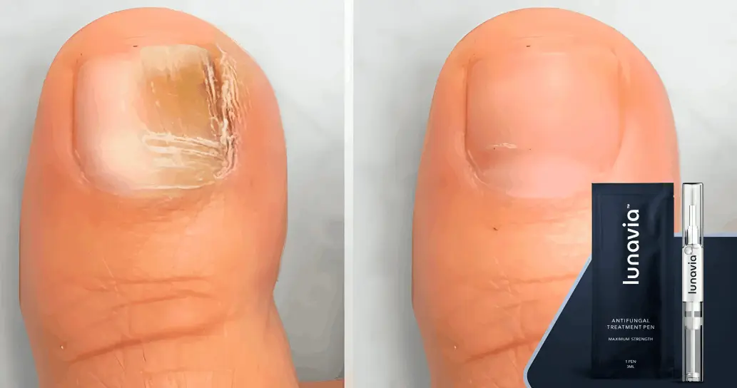 Lunavia Toenail Fungus Pen Customer Reviews